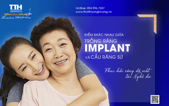 Sự khác biệt giữa trồng răng Implant và cầu răng sứ. Phục hồi răng đã mất tại Nghệ An